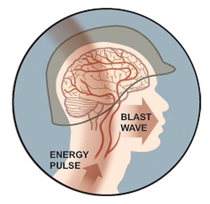 Blast Injury Brainline