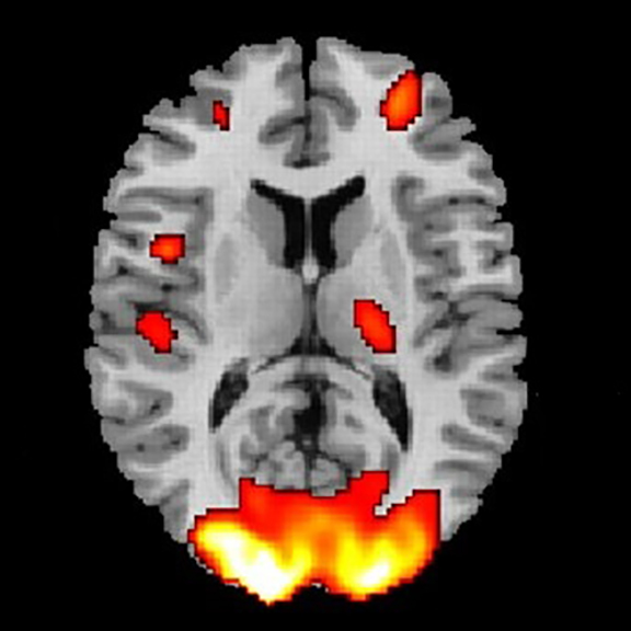 Brain Imaging: What Are | BrainLine