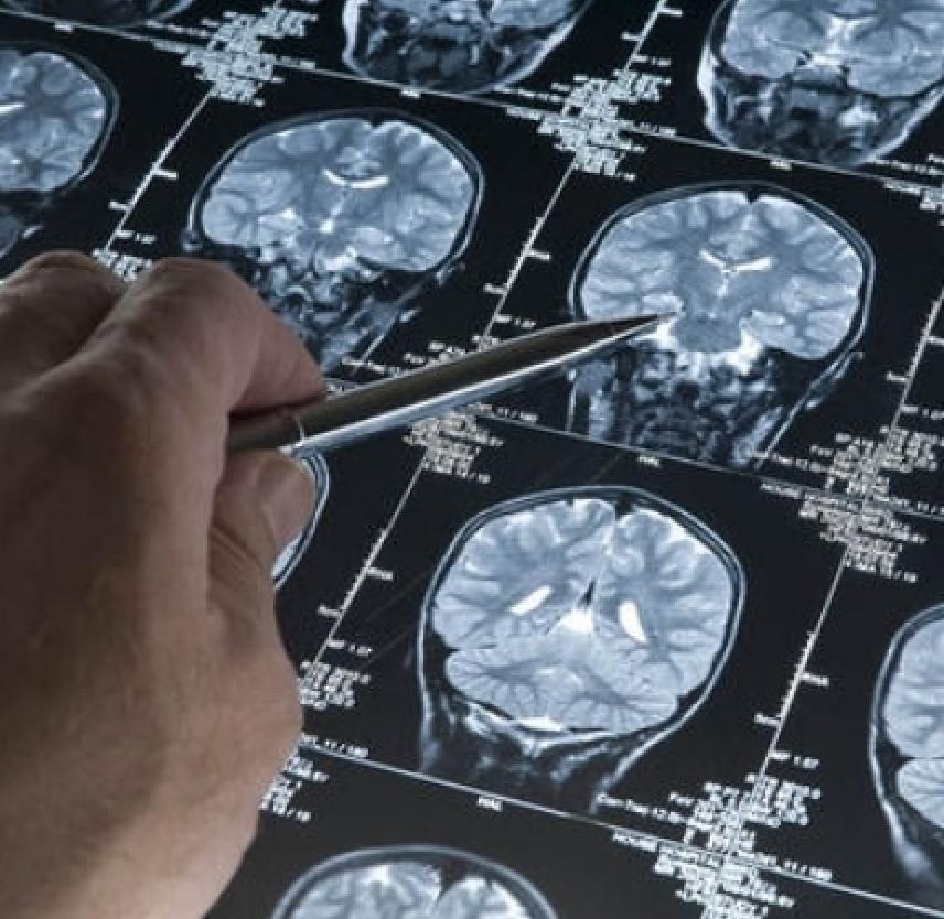 Basic Brain Anatomy and How TBI Can Affect It - Snellings Law